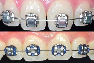 Orthodontics | Alfonso Dental Clinic